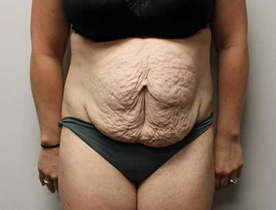 Tummy Tuck before and after - before
