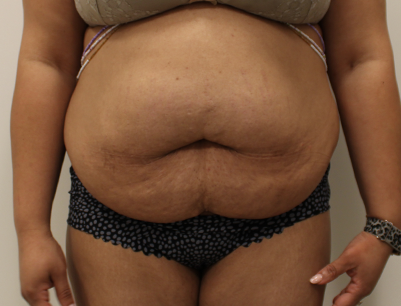 Tummy Tuck before and after - before