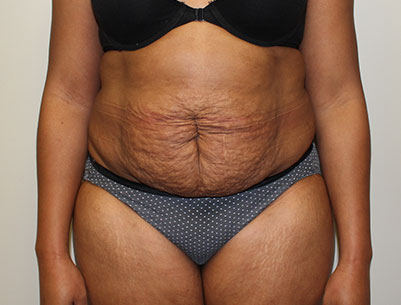 Tummy Tuck before and after - before