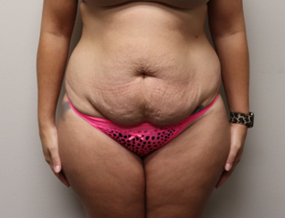 Tummy Tuck before and after - before