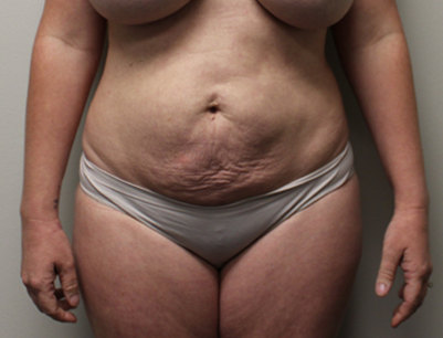 Tummy Tuck before and after - before