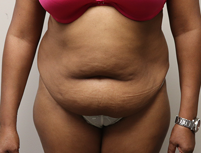 Tummy Tuck before and after - before