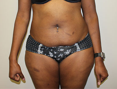 Tummy Tuck before and after - before