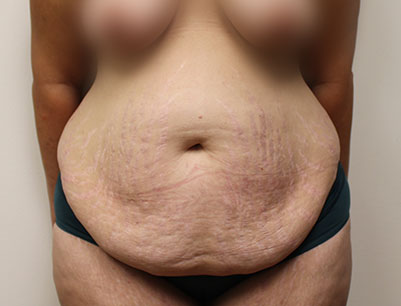 Tummy Tuck before and after - before