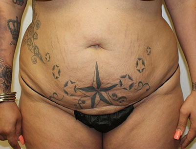 Tummy Tuck before and after - before