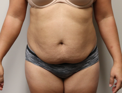Tummy Tuck before and after - before