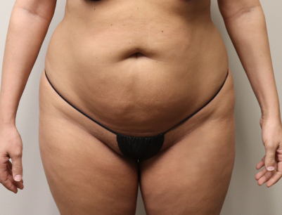 Liposuction before and after - before