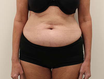 Liposuction before and after - before