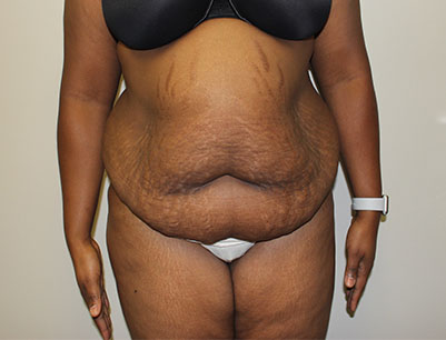 Tummy Tuck before and after - before