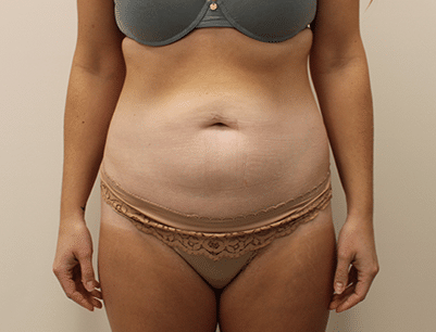 Liposuction before and after - before