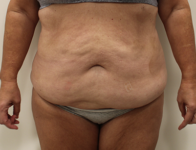 Tummy Tuck before and after - before