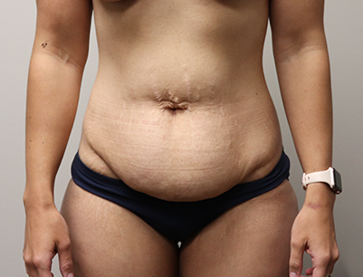 Tummy Tuck before and after - before