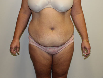 Tummy Tuck before and after - before