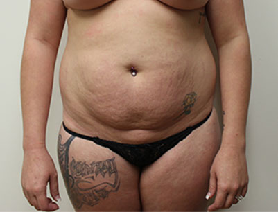 Tummy Tuck before and after - before