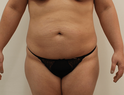 Liposuction before and after - before