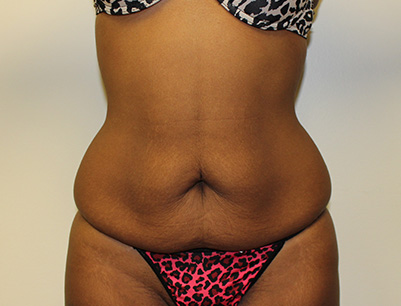 Tummy Tuck before and after - before