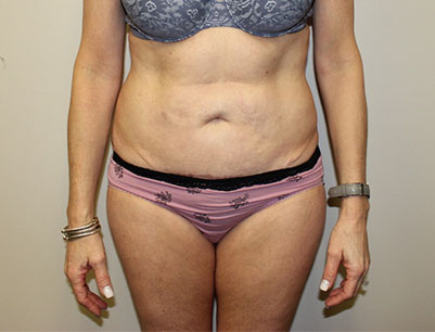 Tummy Tuck before and after - before