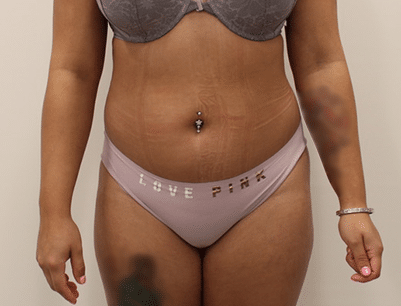 Liposuction before and after - before