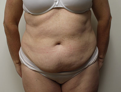 Tummy Tuck before and after - before