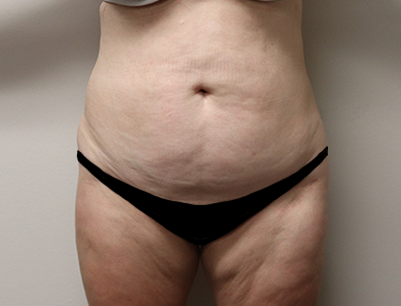 Tummy Tuck before and after - before
