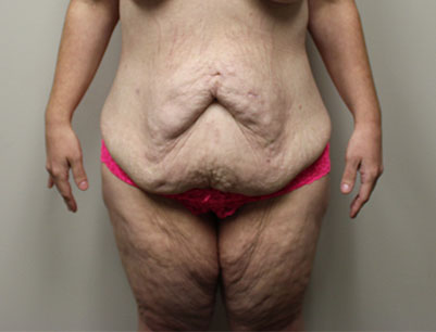 Tummy Tuck before and after - before