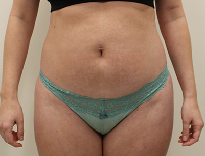Tummy Tuck before and after - before