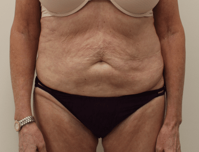 Tummy Tuck before and after - before