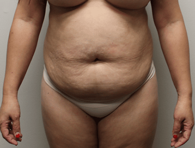 Tummy Tuck before and after - before
