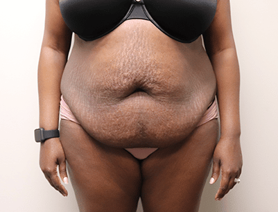 Tummy Tuck before and after - before