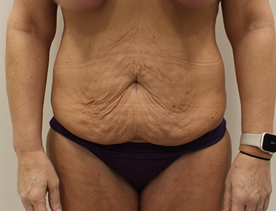 Tummy Tuck before and after - before