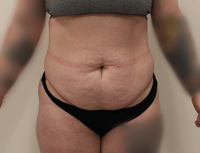 Tummy Tuck before and after - before