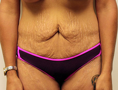 Tummy Tuck before and after - before