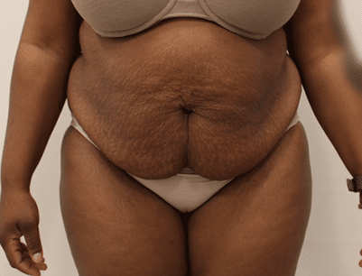 Tummy Tuck before and after - before