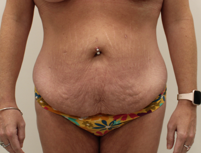 Tummy Tuck before and after - before