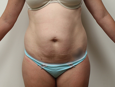 Tummy Tuck before and after - before