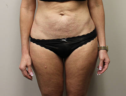 Liposuction before and after - before