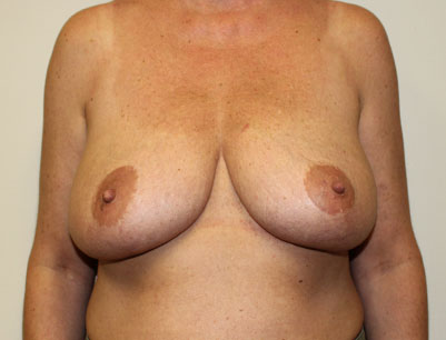 Breast Lift before and after - before