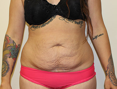 Tummy Tuck before and after - before