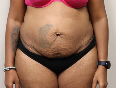 Tummy Tuck before and after - before