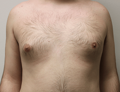 Liposuction before and after - before
