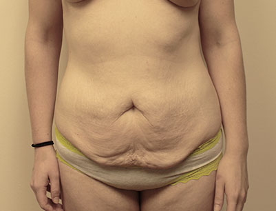 Tummy Tuck before and after - before
