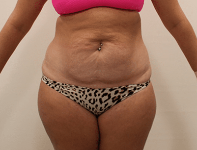 Tummy Tuck before and after - before