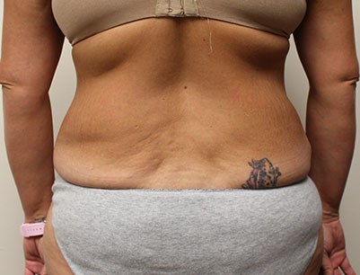 Liposuction before and after - before