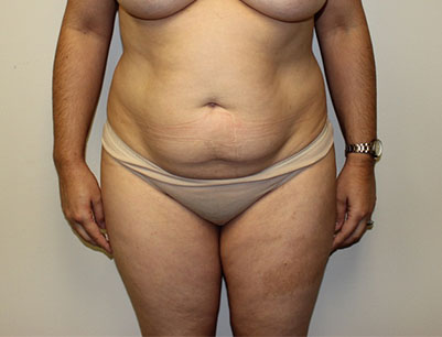 Tummy Tuck before and after - before