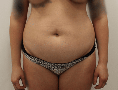 Tummy Tuck before and after - before