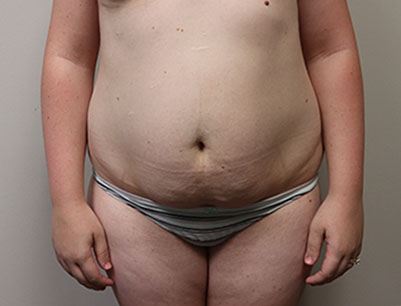 Tummy Tuck before and after - before