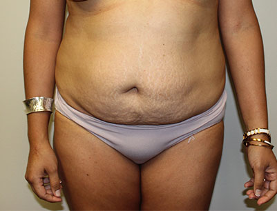 Tummy Tuck before and after - before