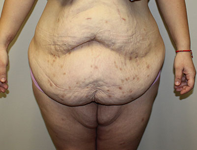 Tummy Tuck before and after - before