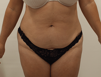 Tummy Tuck before and after - before
