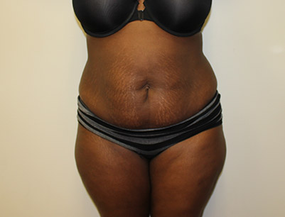 Tummy Tuck before and after - before